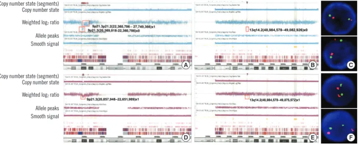 Fig. 1. High-resolution single nucleotide polymorphism array (HR SNP-A) analysis results for chromosome 9 (A) and 13 (B) performed at  diagnosis in Case 1