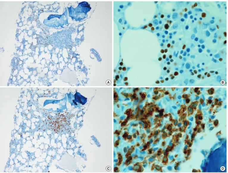 Fig. 1. Bone marrow biopsy after 6 cycles of rituximab, cyclophosphamide, doxorubicin, vincristine and prednisolone (R-CHOP) combina- combina-tion chemotherapy