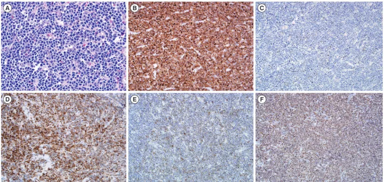 Table 1. Comparison of the current cases with previously reported intermediate BL/DLBCL cases in English literature Case No
