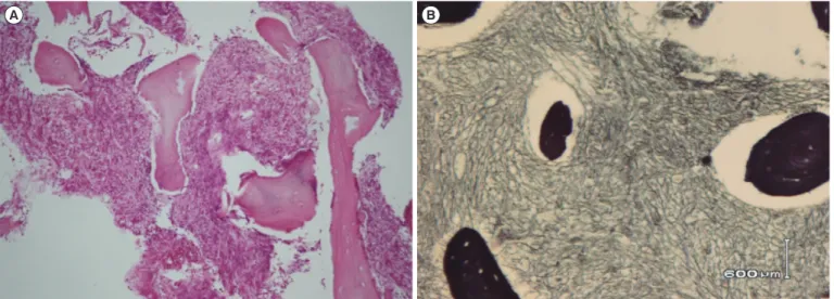 Fig. 2. Patient with Down syndrome exhibiting primary myelofibrosis with pentasomy 21