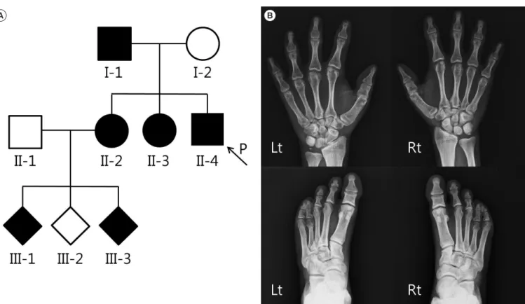 Fig. 2. Sequence analysis of the IHH gene. A heterozygous muta- muta-tion of c.391G>A (p.Glu131Lys) in exon 2 is noted.