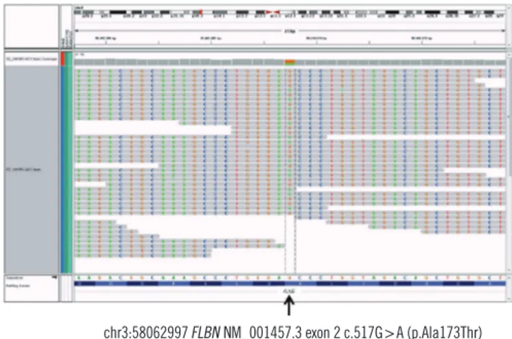 Fig. 3. Integrative Genomics Viewer snapshot of the novel FLNB  mutation (NM_001457.3: c.517G &gt;A; p.Ala173Thr) identified by  exome sequencing.