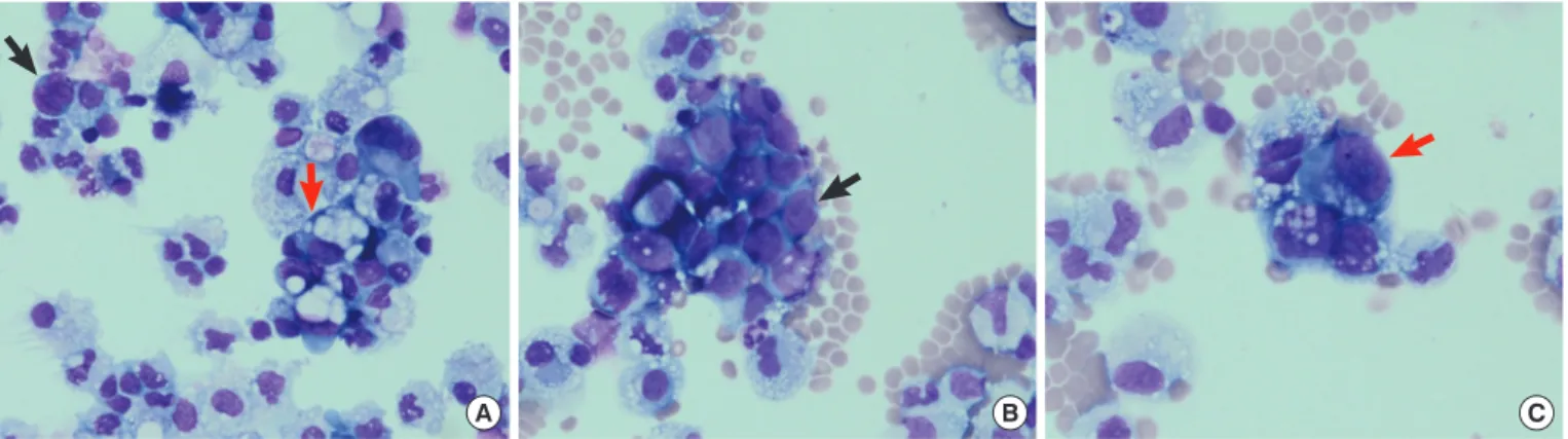 Fig. 2. Cytochemical and immunocytochemical staining results of the two types of neoplastic cells detected in the ascitic fluid
