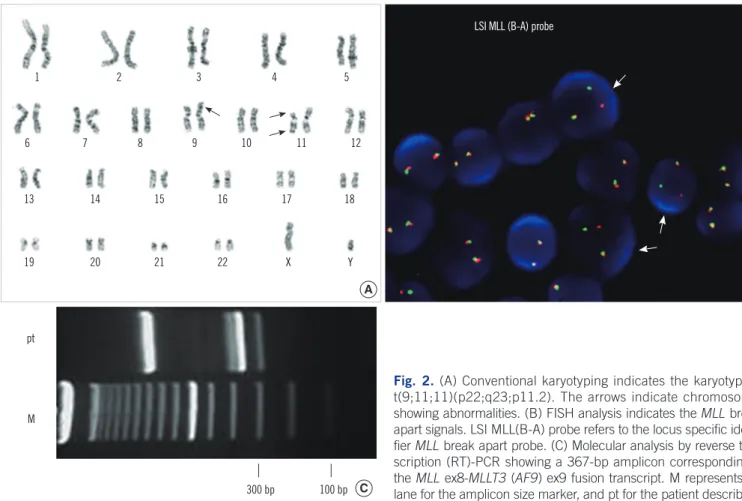Fig. 2. (A) Conventional karyotyping indicates the karyotype of  t(9;11;11)(p22;q23;p11.2)