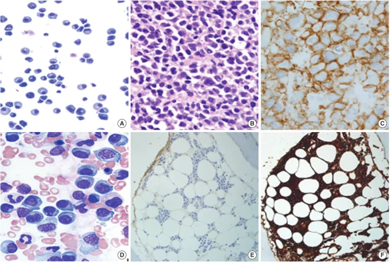 Fig. 1.Histologic examination of the pleural fluid (A), mediastinal mass (B and C), and bone marrow (D, E, and F)