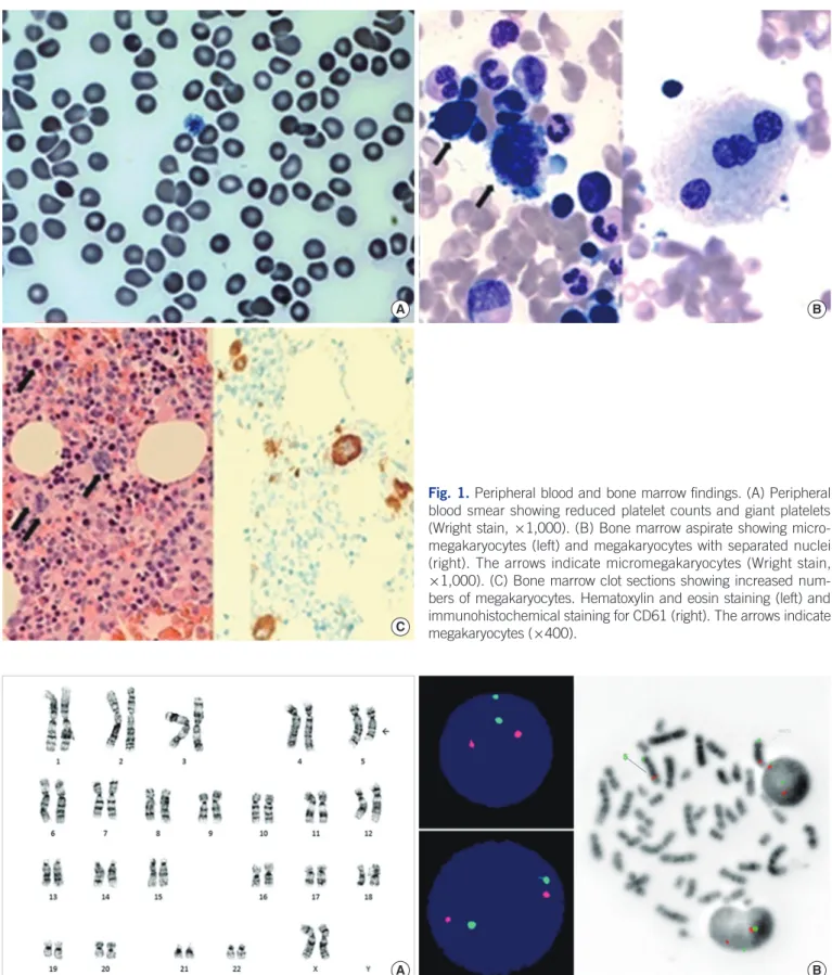 Fig. 1. Peripheral blood and bone marrow findings. (A) Peripheral  blood smear showing reduced platelet counts and giant platelets  (Wright stain, ×1,000)