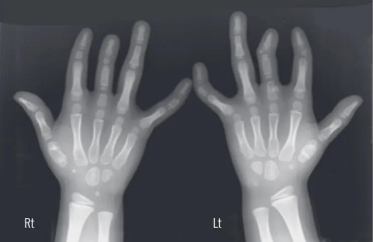 Fig. 1. Radiographic findings of both hands at age 5 yr and 7 months. 