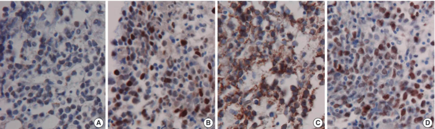 Fig. 1. Immunohistochemistry shows positivity for BCL2 (A), BCL6 (B), CD10 (C), and Ki67 (D) of tumor cells (Femur neck, immunohisto- immunohisto-chemical stains, 400× magnification).