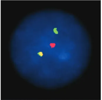 Fig. 4. MLL1/ENL fusion transcript identified by multiplex reverse transcription-PCR. (A) Amplification products of 8 parallel multiplex reverse transcription-PCR  reactions