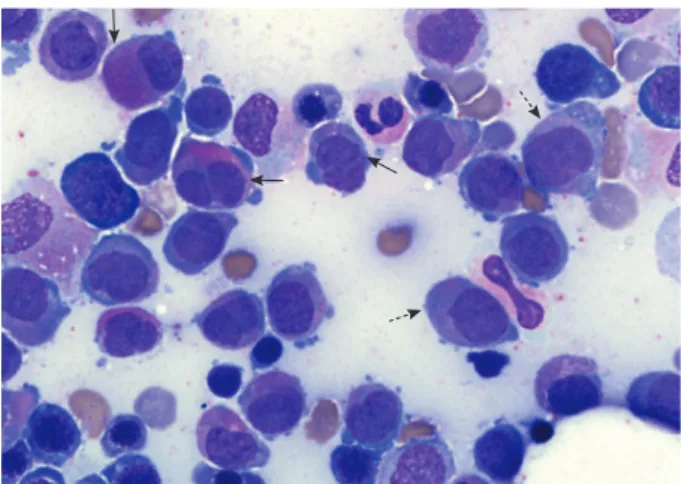 Fig. 2. Chromosome and FISH studies at initial diagnosis. (A) Full  karyogram of the bone marrow cells (major clone) at diagnosis: 