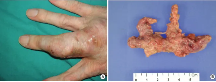 Fig. 1. (A) Subcutaneous lesion on the third finger of the right hand; (B) 6.5×3×1.2 cm-sized mass obtained after removal of the lesion.