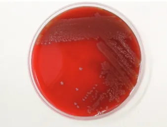 Fig. 2. Gram stain of Streptococcus suis of cerebrospinal fluid showed Gram 