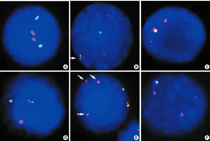 Fig. 2. Interphase FISH using LSI TEL/AML1 Extra Signal probe set. (A) Normal control has two TEL signals (green) and two AML1 signals (orange)