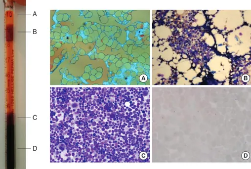 Fig. 1. Myelocrit measurement of a normal bone marrow aspirate  sam-ple in Wintrobe tube and  microsco-pic findings of the separated  lay-ers