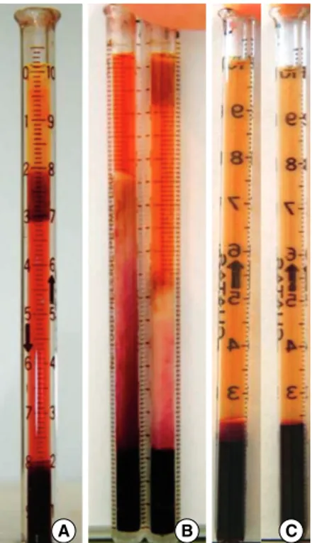 Fig. 2. Myelocrits of bone marrow aspirates of patients with vari- vari-ous diseases. The myelocrit of aplastic anemia (A) shows a long fat layer (22 mm), particle layer (10 mm), plasma layer and a small buffy coat layer (2 mm)