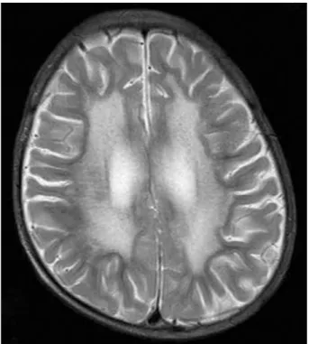 Fig. 1. Brain magnetic resonance image. Axial T2-weighted image shows bilateral, diffuse confluent hyperintensities in the  periven-tricular white matter and cerebral atrophy.