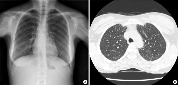 Fig. 1. Images of chest PA and high resolution CT. (A) Chest radiograph shows subtle widespread reticulonodular pattern with peripheral septal thickening