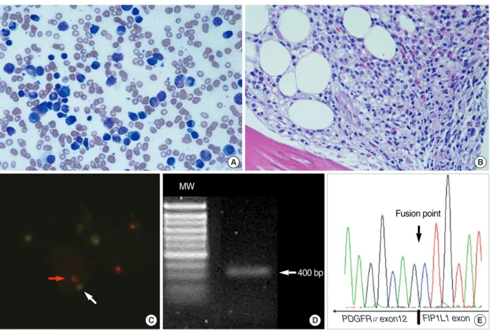 Fig. 1. Morphology and the FIP1L1-PDGFRαrearrangement in a patient with clonal eosinophilia associated with multiple myeloma