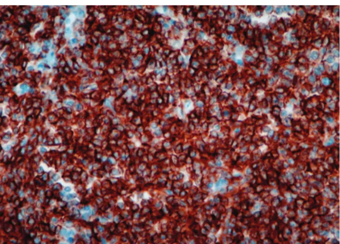 Fig. 4. Immunohistochemical staining of lymph node shows neo- neo-plastic cells with expression of the natural killer (NK) cell antigen, CD56 (×400).