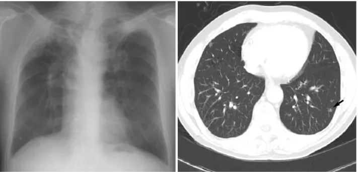 Fig. 1. (A) Simple chest PA done on May 13th, 2002: Lung destroyed due to tuberculosis with volume loss of both upper lung field