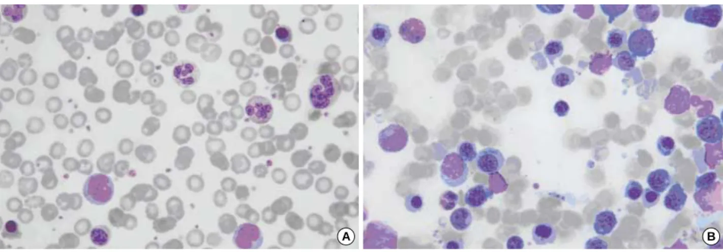 Fig. 1. Leukoerythroblastic reaction and thrombocytosis in peripheral blood smear (A) (Wright Giemsa stain, ×400)