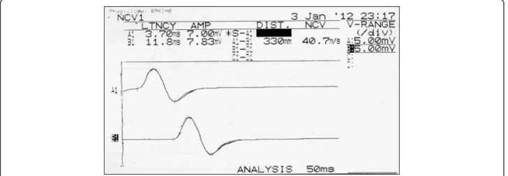 Fig. 2 Representative trace of motor (common peroneal) nerve action potential of right and left legs