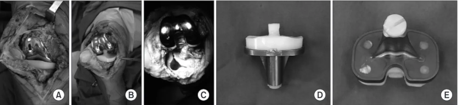 Figure 6. Intraoperative photographs showing (A) moderate synovitis with brown color, (B) flexion medial instability with valgus stress, (C) status of the  cement at the proximal tibia cutting surface after removal of the tibial component by hand, and (D, 