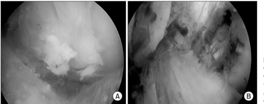 Figure 2. (A) Arthroscopic view shows  whitish calcific material like toothpaste,  which was squeezed and removed from  the ragged posterior cruciate ligament  (PCL)