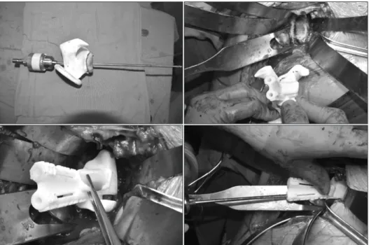 Figure 1. Reverse total shoulder arthroplasty  using a 3-dimensional printed patient specific  guide.