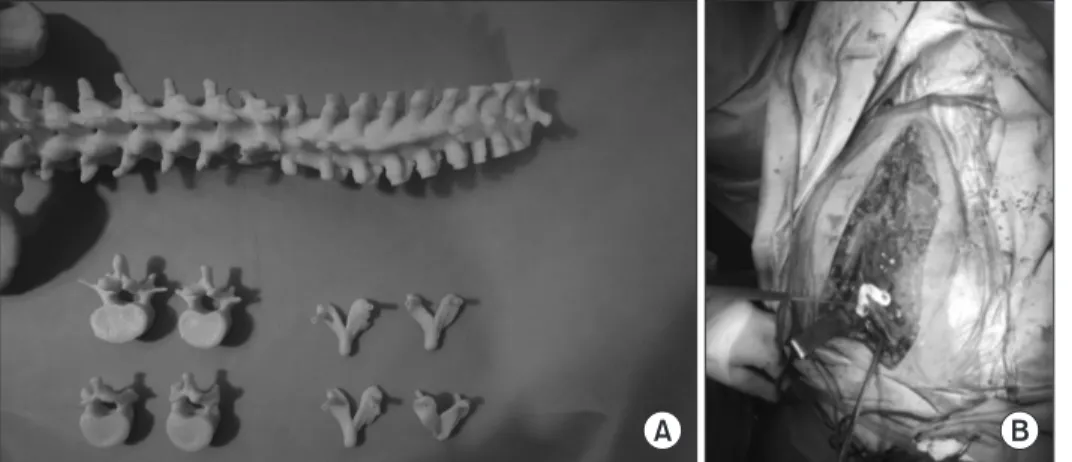 Figure 2. (A) Patient-specific spinal model  using 3-dimensional (3D) printing. (B)  Using 3D-printed patient specific guide  in spinal surgery