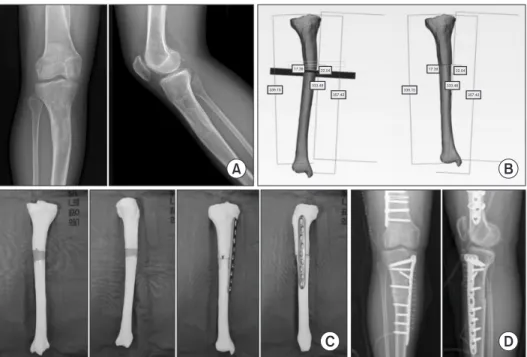 Figure 5. (A) Postoperative X-ray of a patient  with proximal tibia bowing. (B) Preoperative  planning using 3-dimensional (3D) printing  software