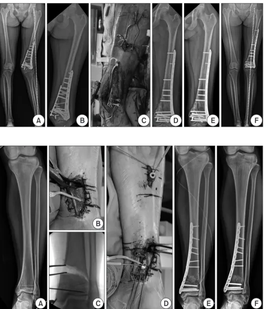 Figure 3. (A, B) A 29-year-old woman  suffered a significant valgus deformity,  which occurred after internal fixation of a  distal femur fracture
