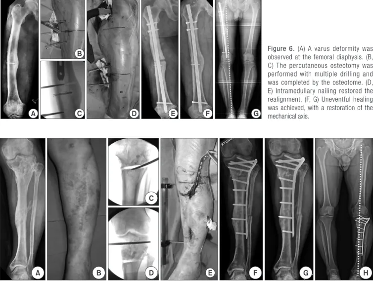 Figure 6. (A) A varus deformity was  observed at the femoral diaphysis. (B,  C) The percutaneous osteotomy was  performed with multiple drilling and  was completed by the osteotome