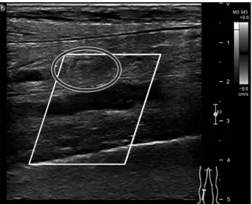 Figure 2. Deep vein thrombosis was diagnosed using Doppler  sonography. 