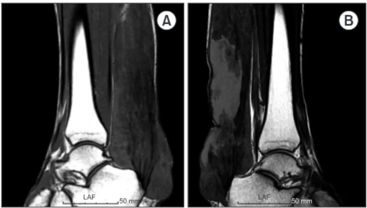 Figure 4. Axial proton density magnetic resonance imaging of both  ankles demonstrates diffuse infiltration of the Achilles tendon with lipid  and inflammatory tissue