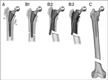 Figure 1. The Vancouver classification of periprosthetic hip fractures is  the most widely used classification system