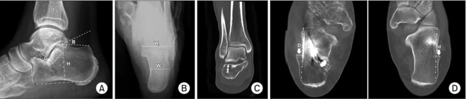 Figure 4. (A, B) Anatomical parameters of normal calcaneal shape. (A) Lateral radiograph