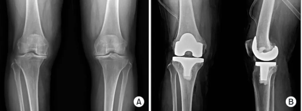 Figure 1. Simple plain radiographs show  osteoarthritis of both knee joints at the  anteroposterior (AP) view (A), and the  right total knee arthroplasty at the AP and  lateral views (B).