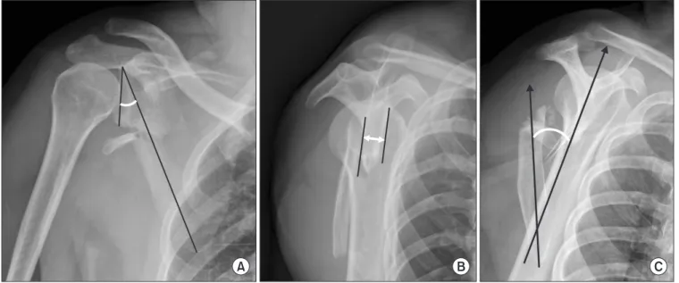 Figure 1. Measurements of the radiographical parameters. (A) The glenopolar angle (GPA) was measured on a true anteroposterior radiograph of the  shoulder