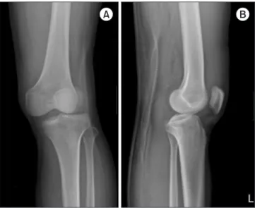 Figure 2. Knee anterior-posterior (A) and lateral (B) radiographs after the  initial reduction trial