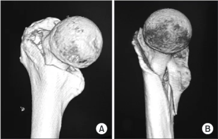 Figure 5. Medial aspect of basicervical (A) and 31-A2 trochanteric  fracture (B) in three-dimensional computed tomography