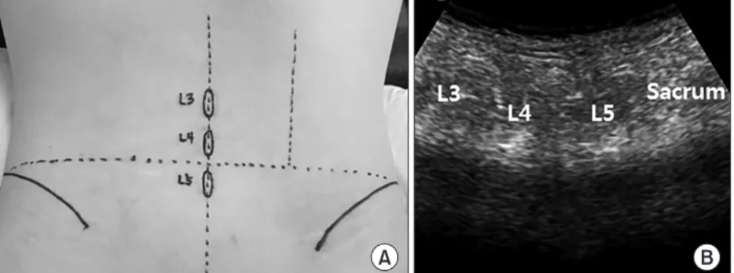 Figure 2. (A) After drawing a line connect- connect-ing the highest point of both iliac crest,  palpate the spinous process of L4, L5