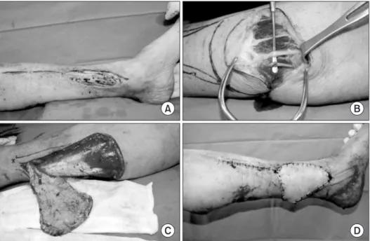Figure 1. After plate removal and wound  debridement (A), the sural nerve and  small saphenous vein were found (B)