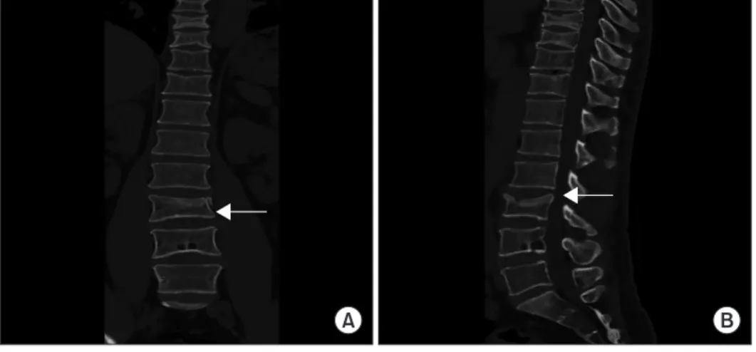 Figure 4. Thoracolumbar (T-L) spine computed  tomography scan coronal view (A) and  sagittal view (B) showing L3 compression  fracture (arrows).