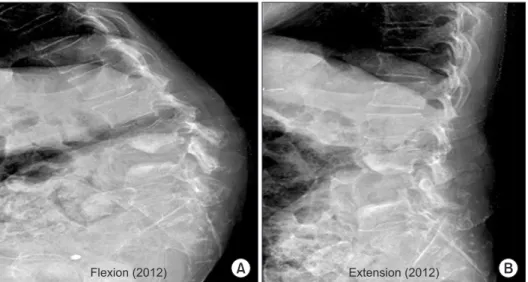 Figure 3. Flexion-extension views in 2012  showed significant instability at the L3-5,  suggesting Charcot spine