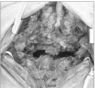 Figure 5. Intraoperatively, the complete dural rupture was identified at  the L3–4. 