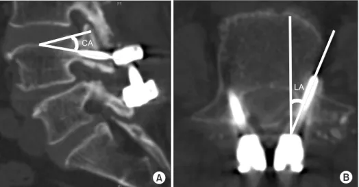 Figure 2. (A, B) Measurements of the  cortical-bone trajectory. CA, cephalad  angle; LA, lateral angle.