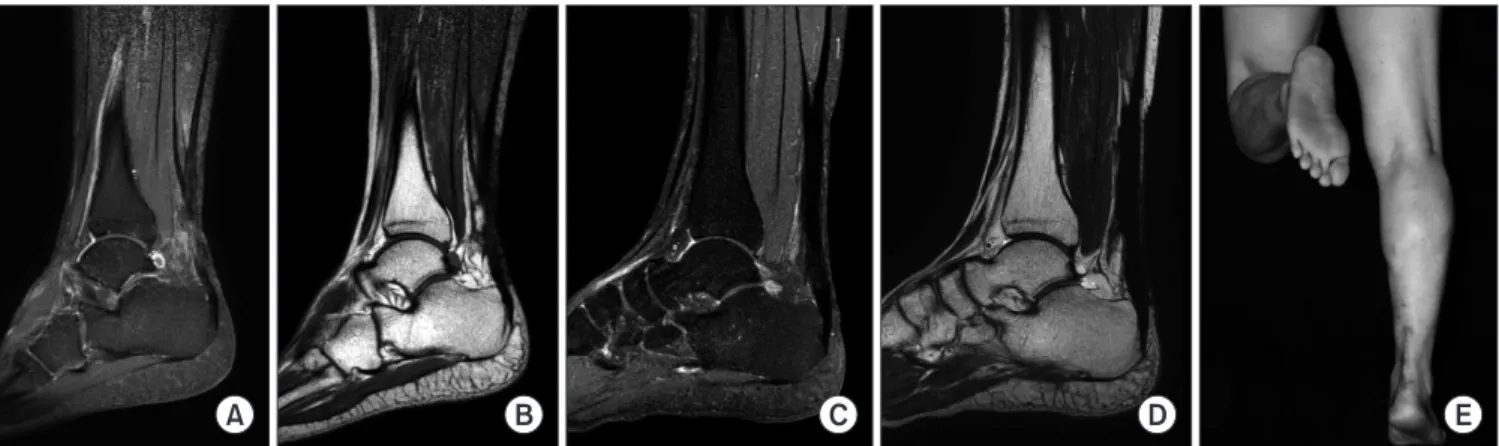 Figure 2. (A, B) Preoperative T1- and T2-weighted magnetic resonance imaging shows infected Achilles tendon around the repair site