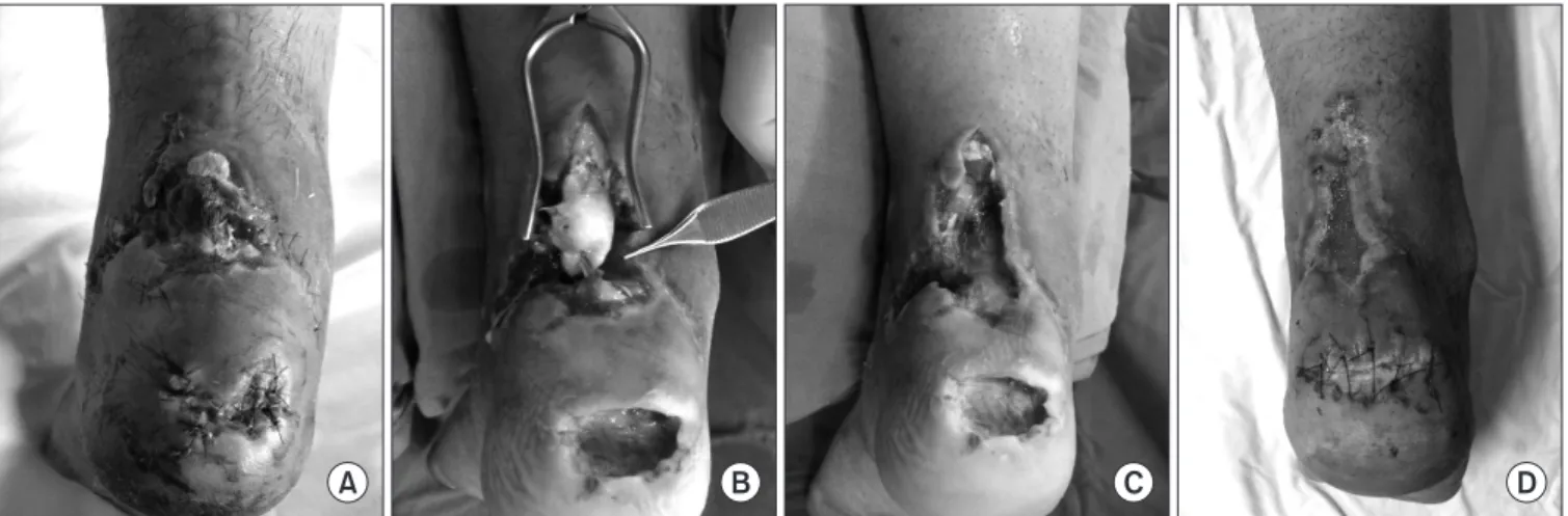 Figure 6. (A, B) Preoperative T1- and T2-weighted magnetic resonance imaging shows the infected Achilles tendon around the repair site