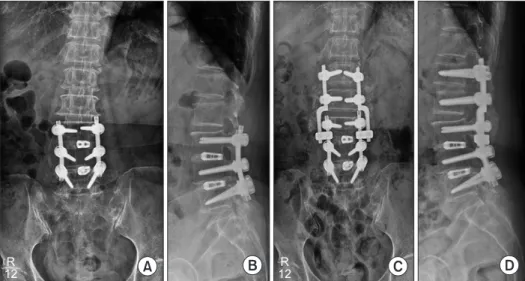 Figure 3. A 70-year-old female had underwent lumbar spine fusion from L3 to L5 (A, B)